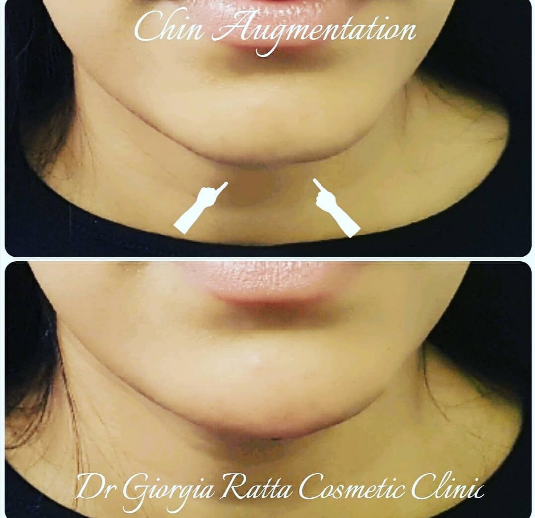 Dr Giorgia Ratta - before and after treatment image