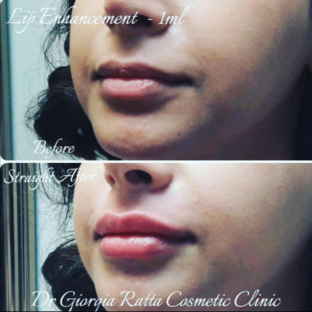 Dr Giorgia Ratta - before and after treatment image