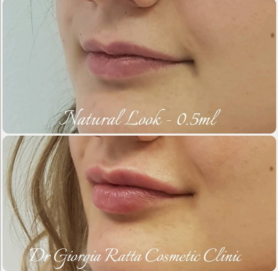 Dr Giorgia Ratta - before and after treatment image